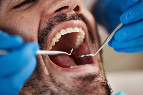 Best Emergency Dental Extractions in Clinton, IL
